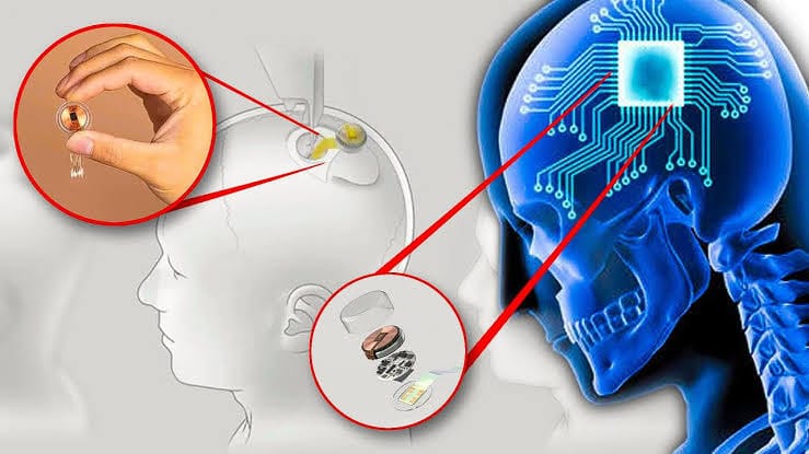 Journey into the Mind: The Groundbreaking Progress of Neuralink post image